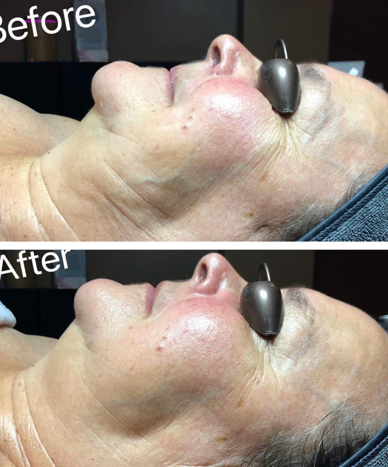 Side-by-side photos of a woman’s face in profile labeled Before and After, showing reduced wrinkles and smoother skin after a facial treatment. She is wearing protective eye covers in both images. About Kris