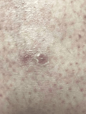 Close-up of skin showing a small, slightly raised reddish-purple spot with surrounding faint red dots and some visible hair. The area appears mildly irritated or inflamed.