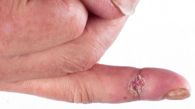 A close up view of a finger with Scleroderma