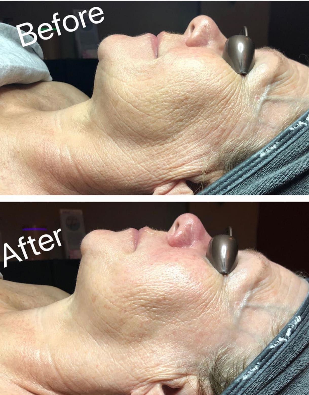 Side-by-side images of a woman’s face before and after a skincare treatment. The Before image shows more visible wrinkles and uneven skin texture, while the After image shows smoother, firmer-looking skin.