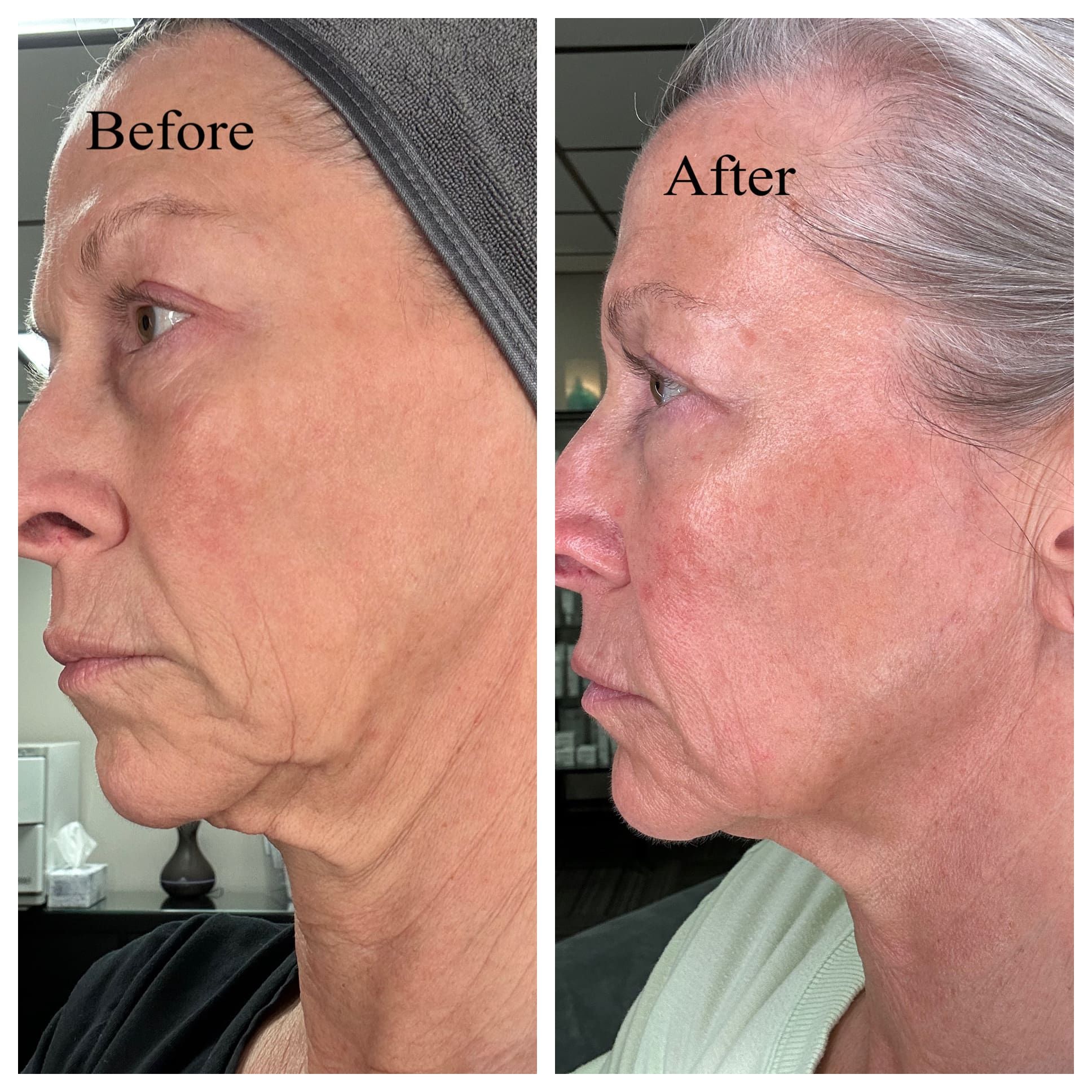 Side-by-side comparison of a woman’s face before and after a jet plasma treatment, showing reduced wrinkles and firmer skin in the After image. Both images are profile views in similar lighting.